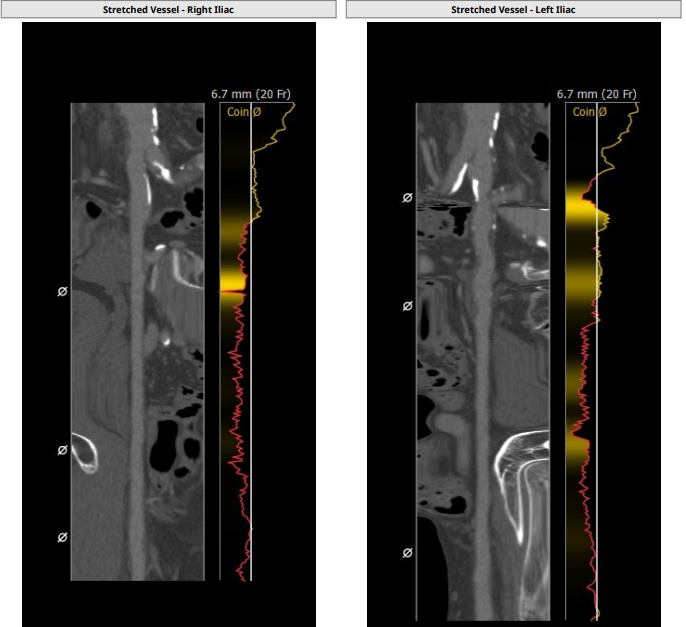 南方医科大学顺德医院心血管内科黎文生主任团队完成重度钙化 TYPE1 型二叶瓣 TAVR 一例