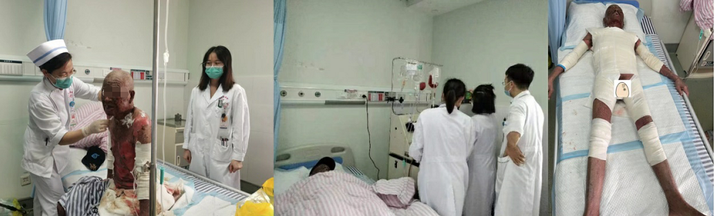 皮肤表皮大面积坏死！广西自治区人民医院多学科联合救治助康复
