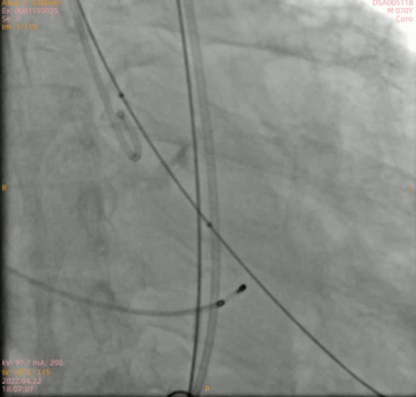南方医科大学顺德医院心血管内科黎文生主任团队完成重度钙化 TYPE1 型二叶瓣 TAVR 一例