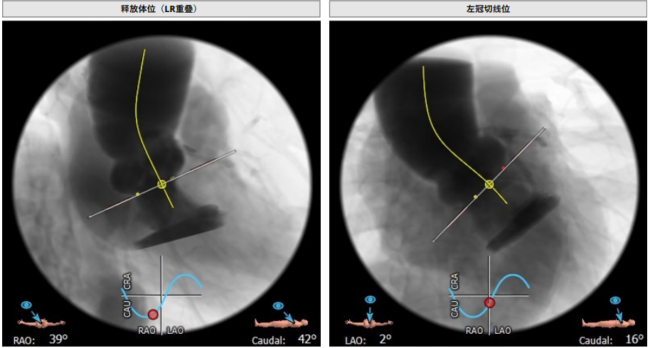 南方医科大学顺德医院心血管内科黎文生主任团队完成重度钙化 TYPE1 型二叶瓣 TAVR 一例