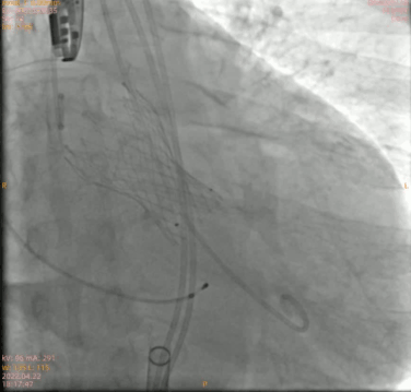 南方医科大学顺德医院心血管内科黎文生主任团队完成重度钙化 TYPE1 型二叶瓣 TAVR 一例
