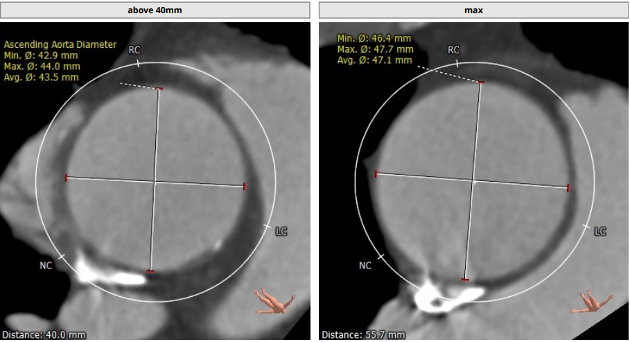 南方医科大学顺德医院心血管内科黎文生主任团队完成重度钙化 TYPE1 型二叶瓣 TAVR 一例