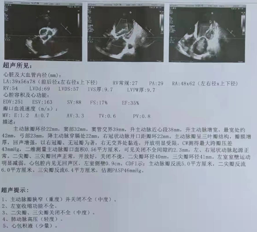 南方医科大学顺德医院心血管内科黎文生主任团队完成重度钙化 TYPE1 型二叶瓣 TAVR 一例