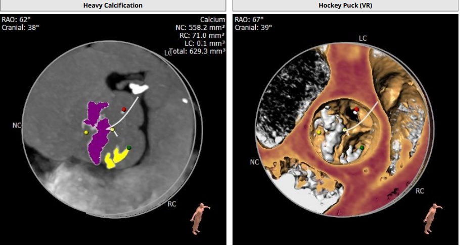 南方医科大学顺德医院心血管内科黎文生主任团队完成重度钙化 TYPE1 型二叶瓣 TAVR 一例