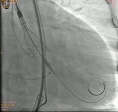南方医科大学顺德医院心血管内科黎文生主任团队完成重度钙化 TYPE1 型二叶瓣 TAVR 一例