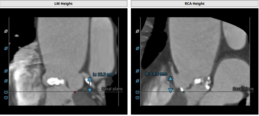 南方医科大学顺德医院心血管内科黎文生主任团队完成重度钙化 TYPE1 型二叶瓣 TAVR 一例