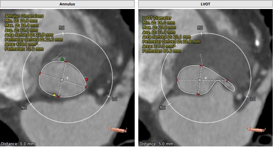 南方医科大学顺德医院心血管内科黎文生主任团队完成重度钙化 TYPE1 型二叶瓣 TAVR 一例