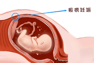 除了剖宫产，瘢痕妊娠发病原因还有哪些？