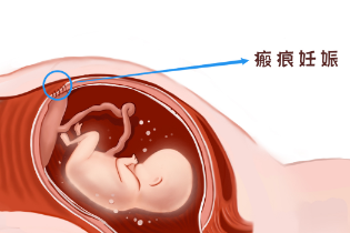 胎儿着床瘢痕处，瘢痕妊娠可开不得玩笑