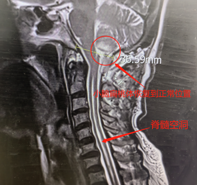 2 小时搞定！脑子「出轨」11 年，胳膊麻木险瘫痪