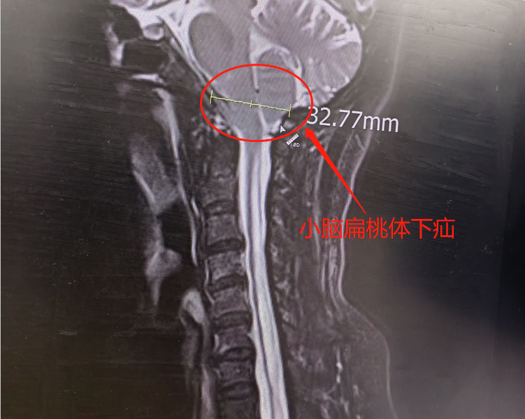 2 小时搞定！脑子「出轨」11 年，胳膊麻木险瘫痪