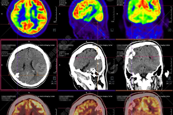 高尚病例：Sturge-Weber 综合征合并癫痫的 PET/CT 显像 1 例