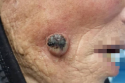 82 岁老人面部突然长黑色疙瘩，竟是角化棘皮瘤