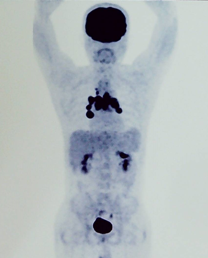 胡凯：CD19&CD22 CAR-T 治疗失败的弥漫大 B 细胞淋巴瘤的挽救性治疗