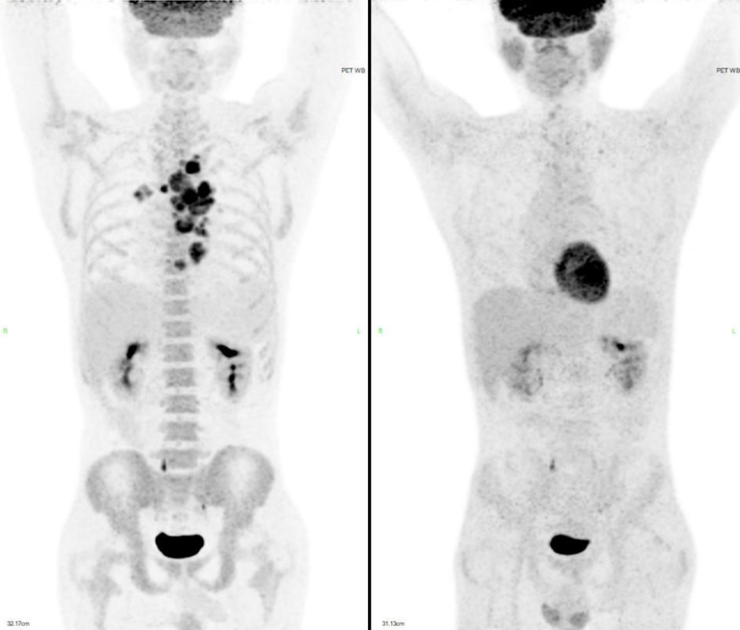 胡凯：CD19&CD22 CAR-T 治疗失败的弥漫大 B 细胞淋巴瘤的挽救性治疗