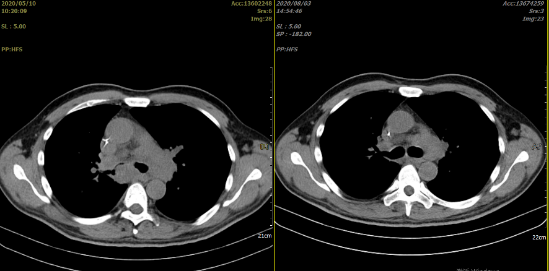 胡凯：CD19&CD22 CAR-T 治疗失败的弥漫大 B 细胞淋巴瘤的挽救性治疗