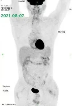 胡凯：CD19&CD22 CAR-T 治疗失败的弥漫大 B 细胞淋巴瘤的挽救性治疗