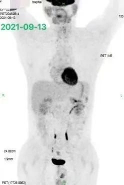 胡凯：CD19&CD22 CAR-T 治疗失败的弥漫大 B 细胞淋巴瘤的挽救性治疗