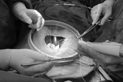 九江市第一人民医院胸心外科完成两例高难度心脏手术
