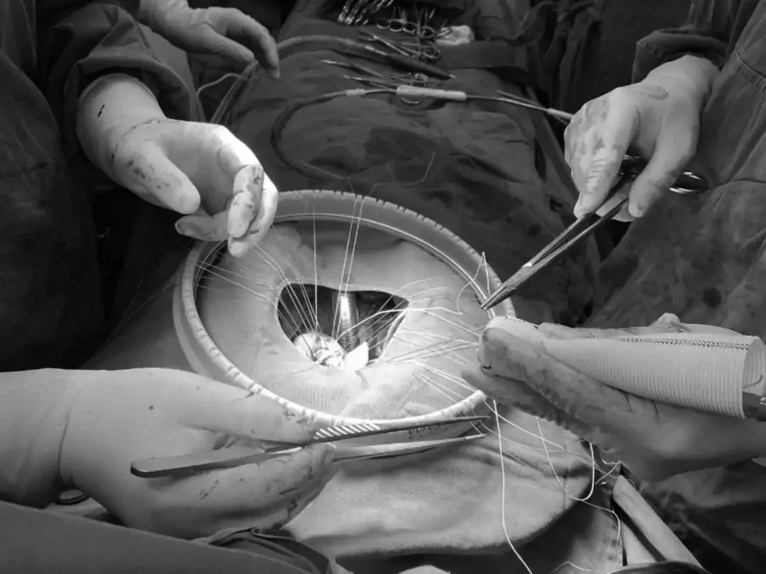 九江市第一人民医院胸心外科完成两例高难度心脏手术