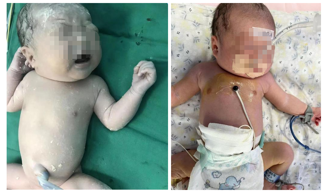 刚出生的「白纸」宝宝 就进行了「换血」术……