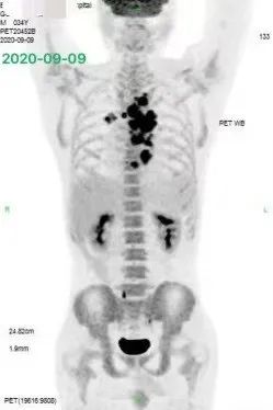 胡凯：CD19&CD22 CAR-T 治疗失败的弥漫大 B 细胞淋巴瘤的挽救性治疗