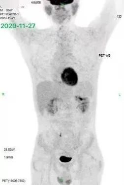 胡凯：CD19&CD22 CAR-T 治疗失败的弥漫大 B 细胞淋巴瘤的挽救性治疗