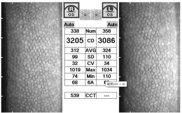 内皮细胞变异指数(cv)角膜内皮计数与年龄相关,角膜内皮细胞密度 2000