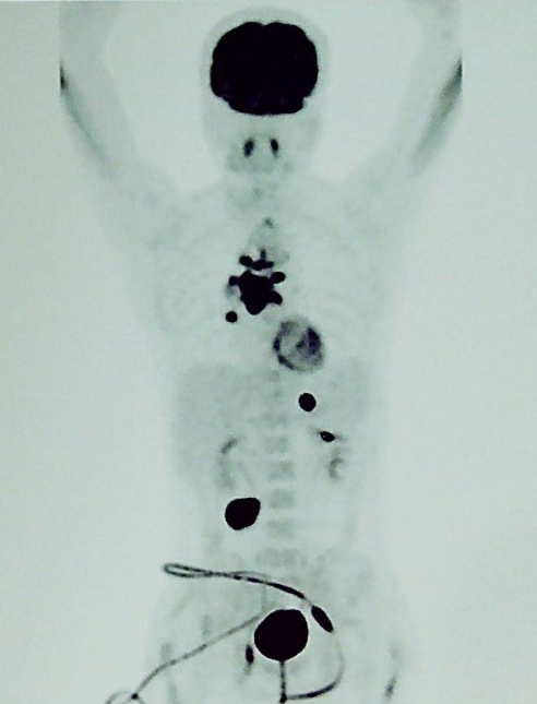 胡凯：CD19&CD22 CAR-T 治疗失败的弥漫大 B 细胞淋巴瘤的挽救性治疗