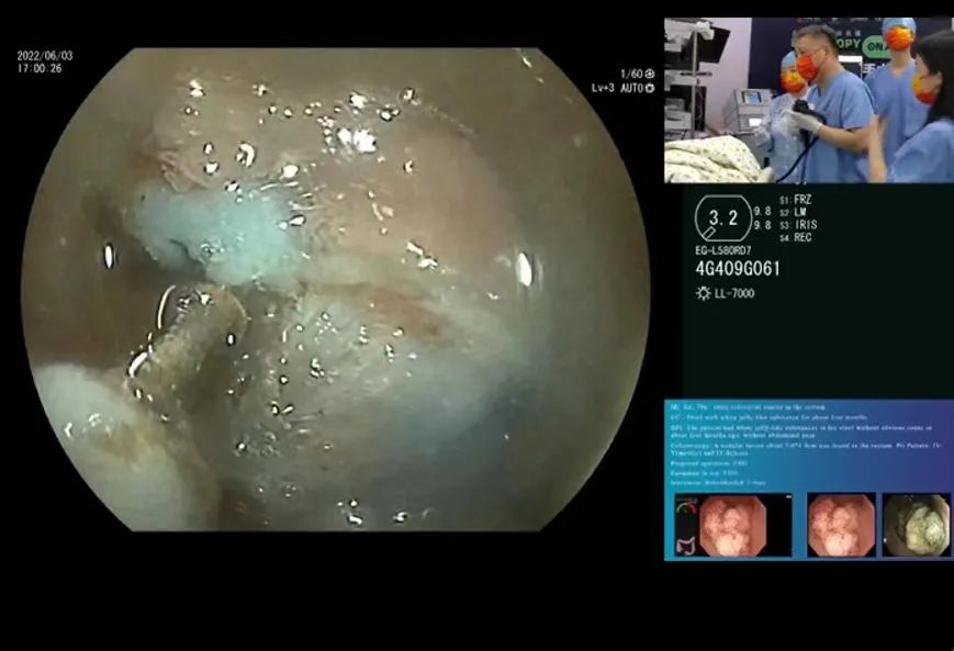 武汉大学人民医院消化医院智造「内镜精灵」惊艳全球