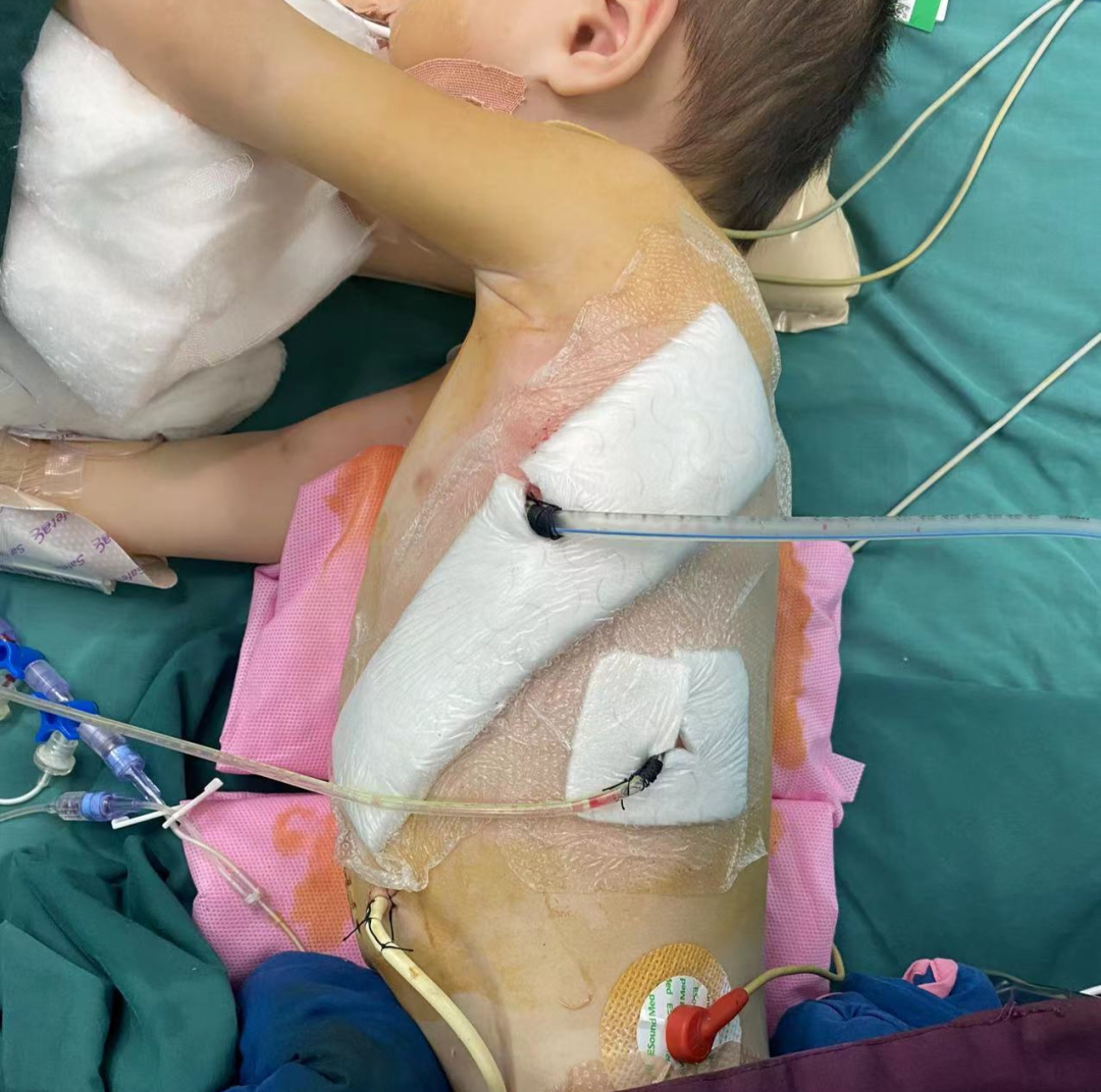 生死时速：2 岁男童胃部"阀门"失效反复呕吐，带着 7 根管子转入大兴
