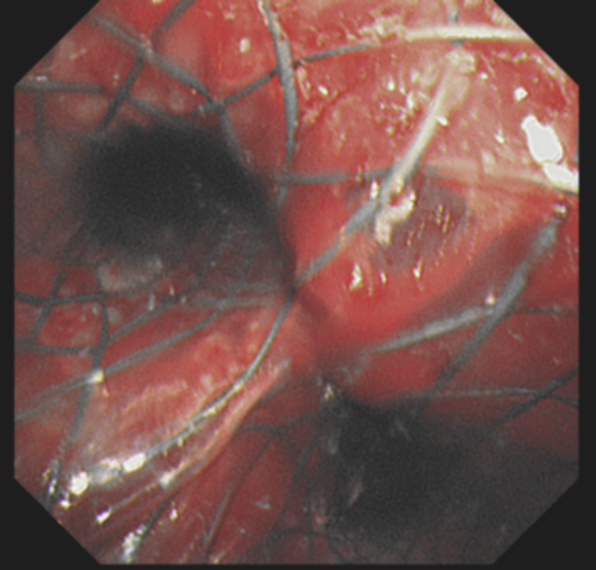 肺癌魔爪掐住老人脖子  武汉市肺科医院医生数分钟打通生命「隧道」
