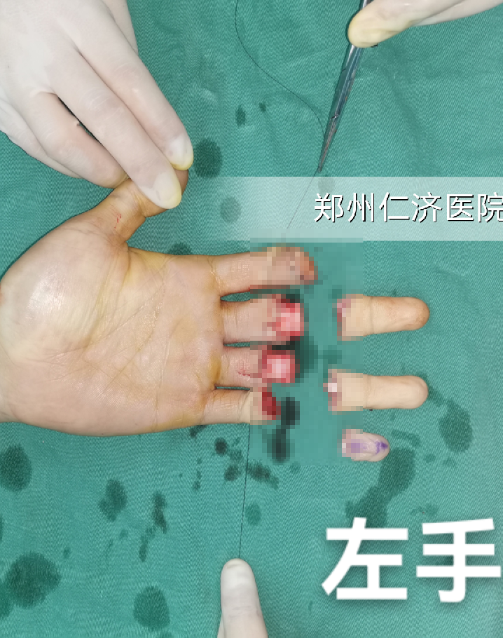 断了八根手指，历时 10 个小时，郑州仁济医院再植成功