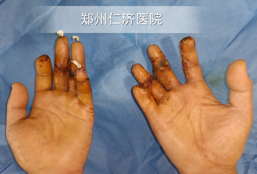 断了八根手指，历时 10 个小时，郑州仁济医院再植成功