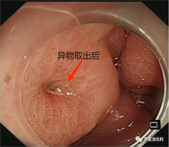 76 岁阿姨突发上腹剧痛，竟是枣核惹的祸......
