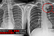 悬吊动态将开启普通放射学检查新纪元