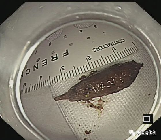 76 岁阿姨突发上腹剧痛，竟是枣核惹的祸......