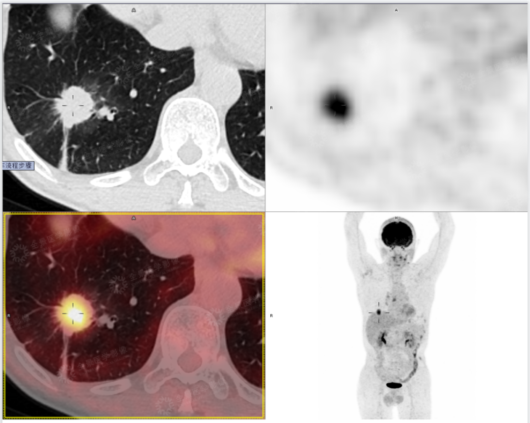 吸烟，让肺癌死亡风险提升 50 倍！