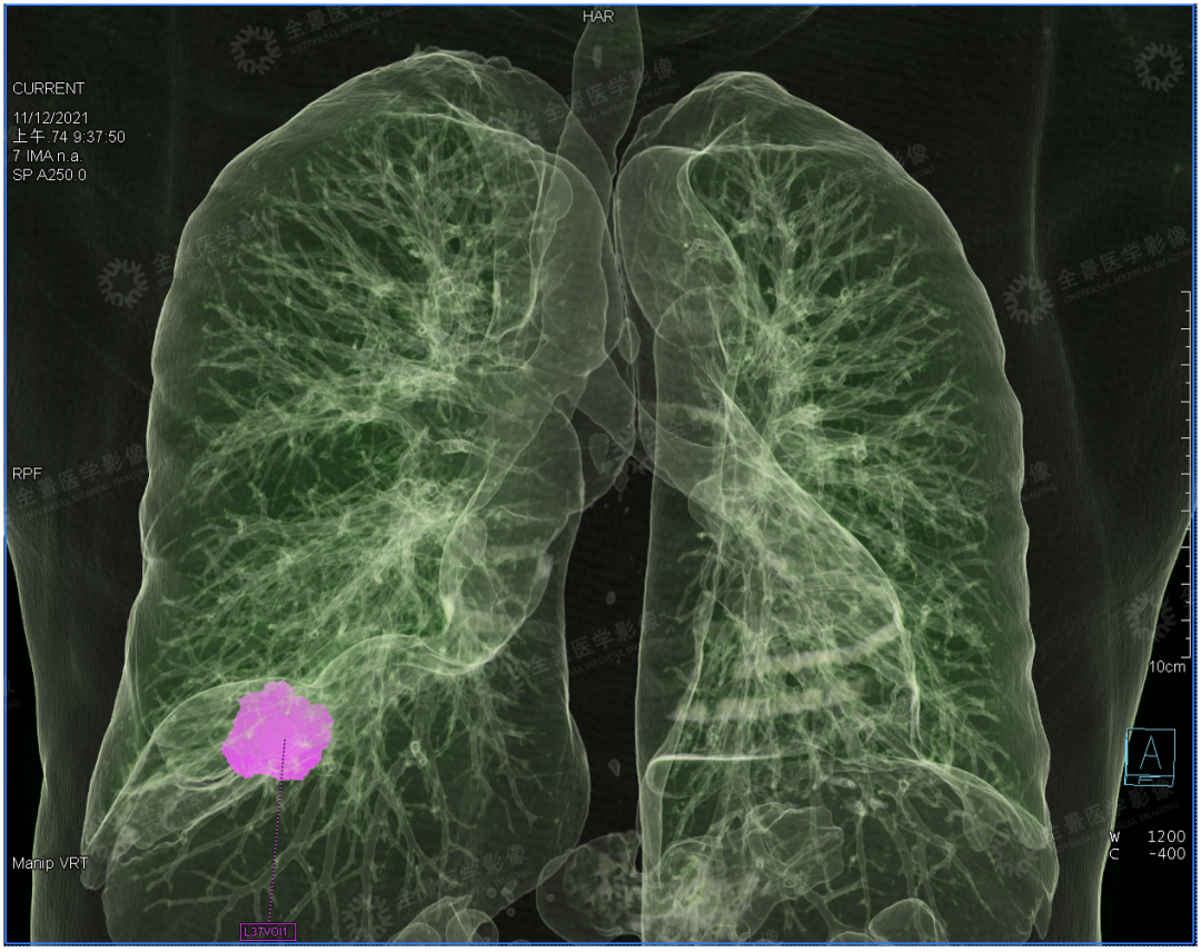 吸烟，让肺癌死亡风险提升 50 倍！