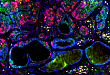 麻省总医院发现特定免疫细胞可使乳腺癌细胞转变为良性囊肿组织