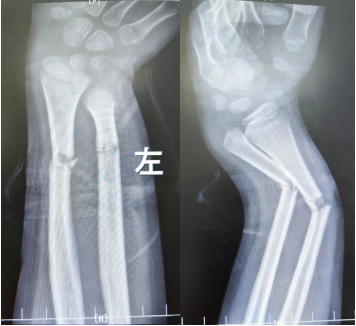 不开大刀！儿童骨折治疗的「利器」—— 弹性髓内钉技术