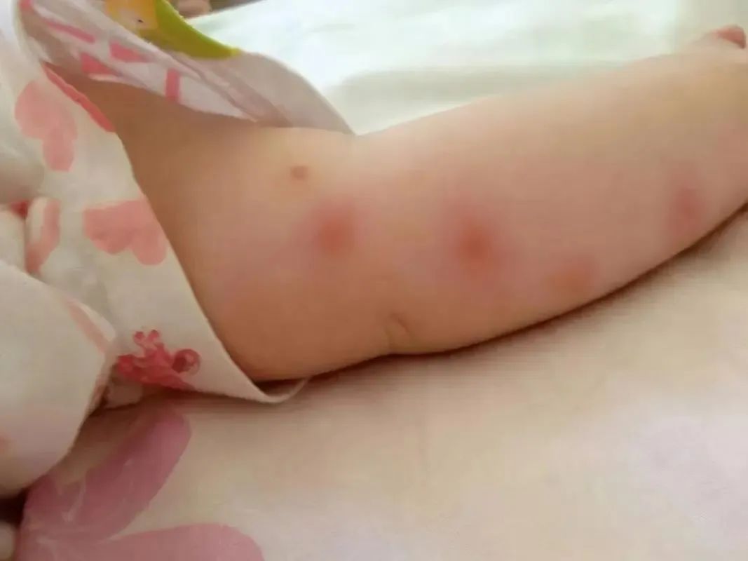 小蚊子，大危害！不少孩子因蚊虫叮咬住院