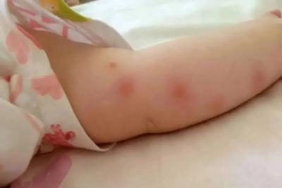小蚊子，大危害！不少孩子因蚊虫叮咬住院