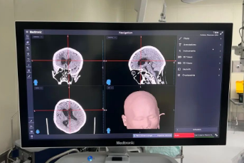 大脑手术的「第三只眼」——浙北地区首台 S8 光磁手术导航定位系统落户湖州市中心医院