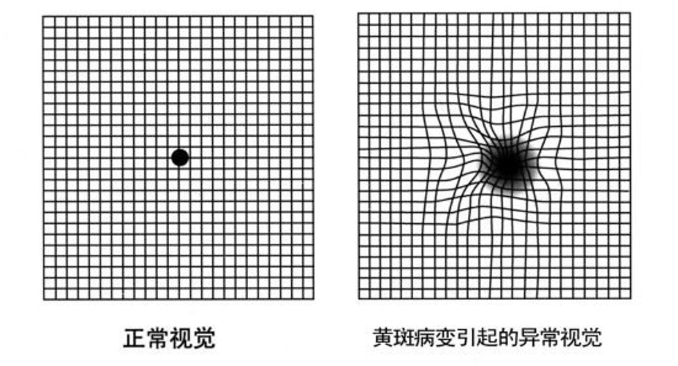 黄斑病变严重可致盲！南京江北医院眼科提醒眼底检查很重要