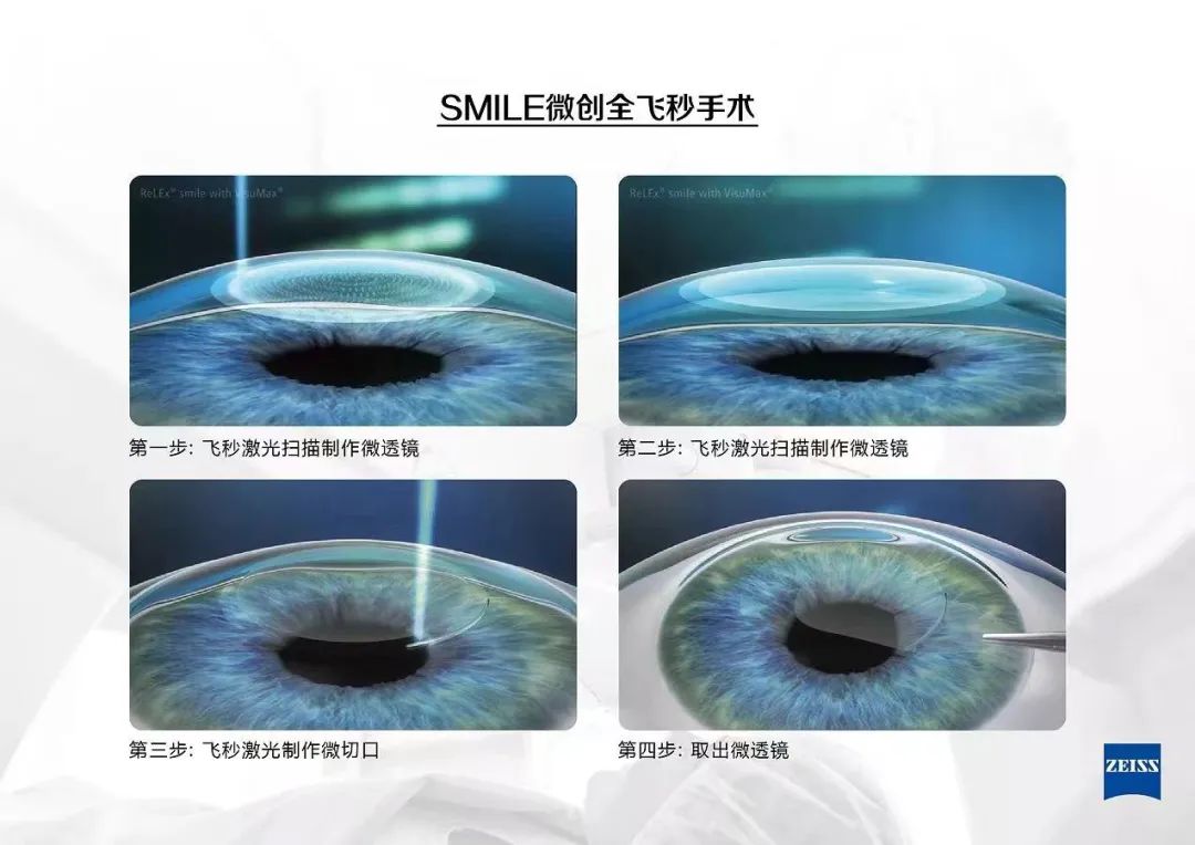 高考后想做近视手术？你得先知道这些