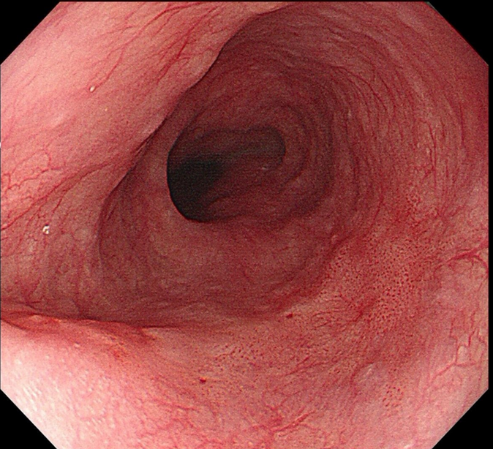 放大 150 倍!「升级版」胃肠镜揪消化道早癌快、准、狠!