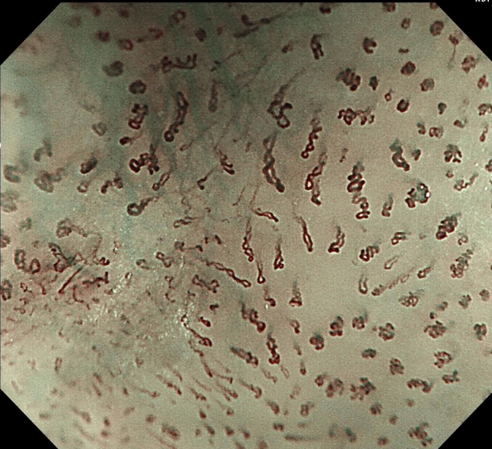 放大 150 倍!「升级版」胃肠镜揪消化道早癌快、准、狠!