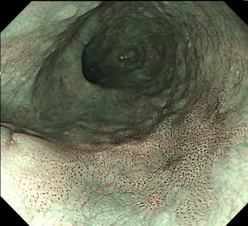 放大 150 倍!「升级版」胃肠镜揪消化道早癌快、准、狠!