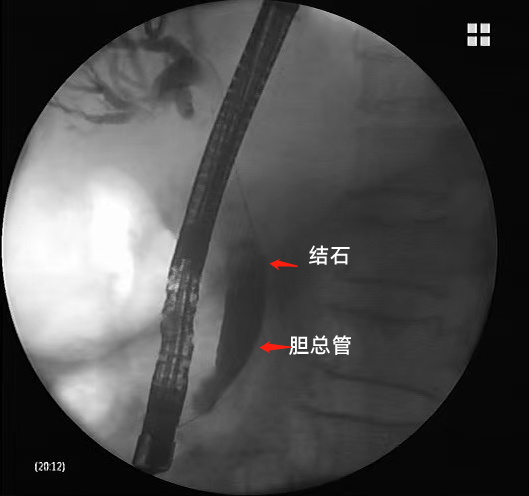 广西壮族自治区人民医院多学科联合救治一名感染性休克患者